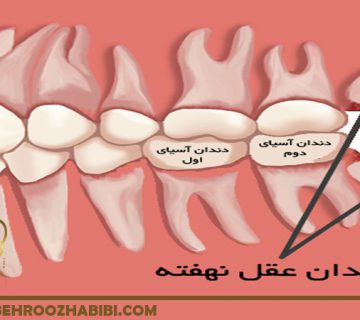 جراحی دندان عقل