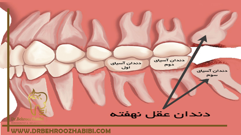 جراحی دندان عقل