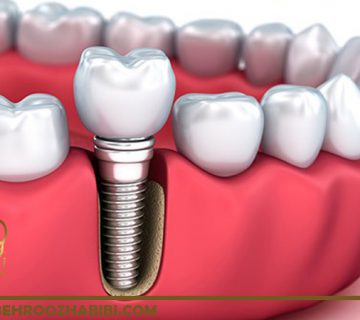 ایمپلنت دندان در تهران