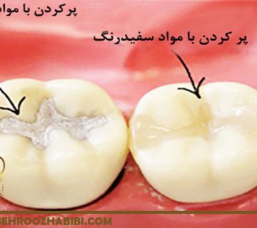 پر کردن دندان در تهران
