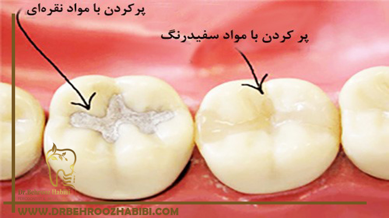 پر کردن دندان در تهران