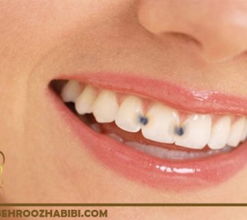 ترمیم دندان های خراب