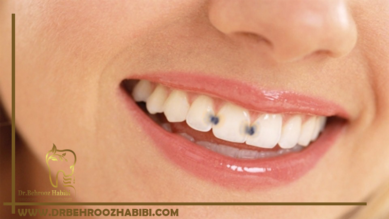 ترمیم دندان های خراب