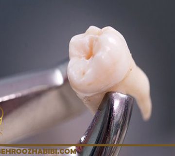 پرکردن حفره دندان در تهران