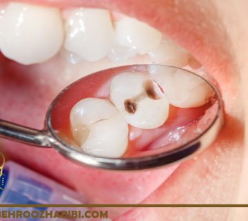 ترمیم حفره دندان