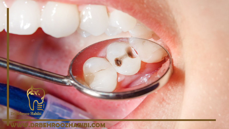 ترمیم حفره دندان