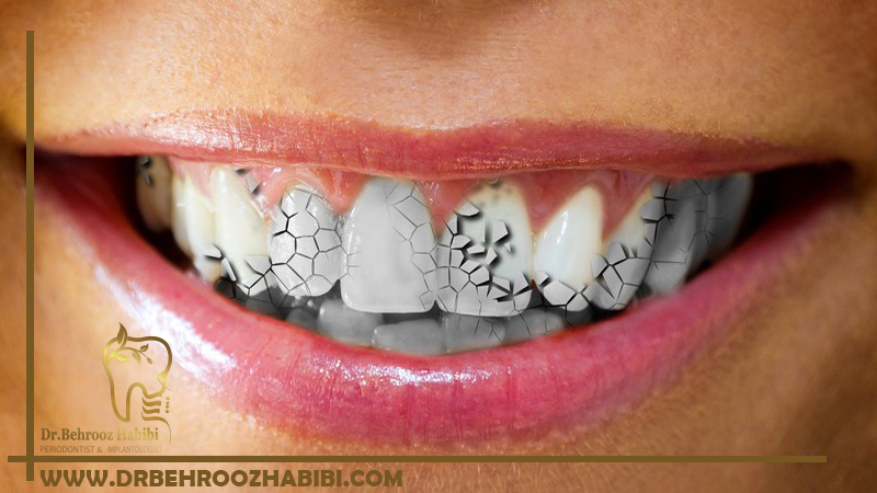 ترمیم دندان ترک خورده در تهران