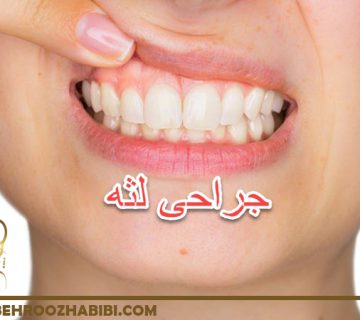 جراحی لثه در تهران
