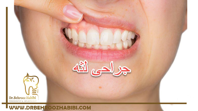 جراحی لثه در تهران