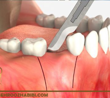 جراحی پریودنتال