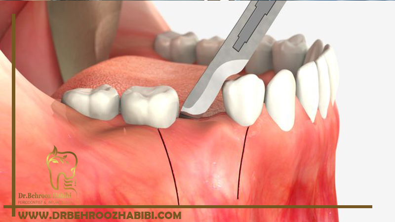جراحی پریودنتال