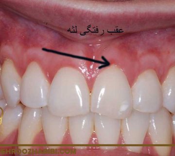 درمان عقب‌ رفتگی لثه