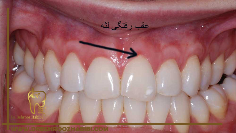 درمان عقب‌ رفتگی لثه