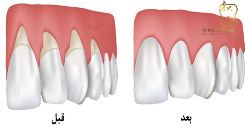 درمان عقب‌ رفتگی لثه