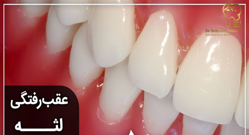 درمان عقب‌ رفتگی لثه