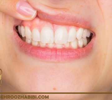 درمان لثه های سفید
