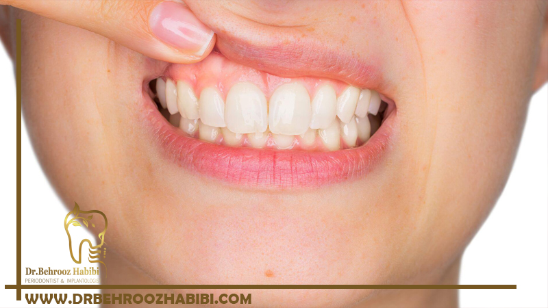 درمان لثه های سفید