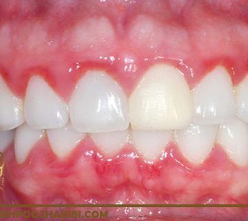 لثه های سفید