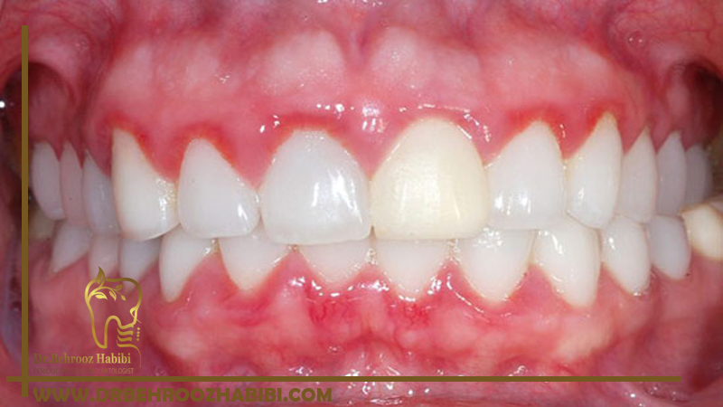 لثه های سفید