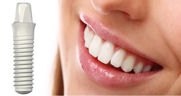 ایمنی ایمپلنت های دندان