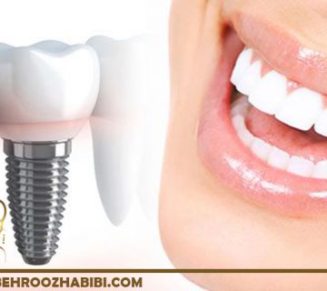 ایمپلنت دندان در تهران