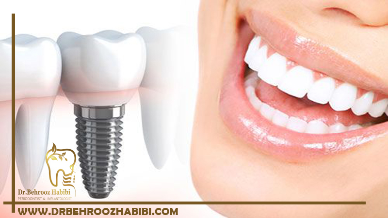 ایمپلنت دندان در تهران