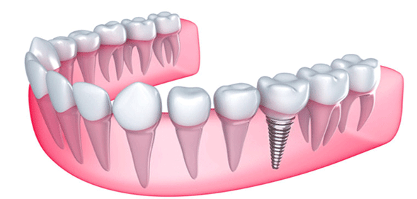 ایمپلنت دندان در تهران