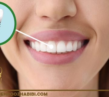 ایمپلنت دندانی در تهران