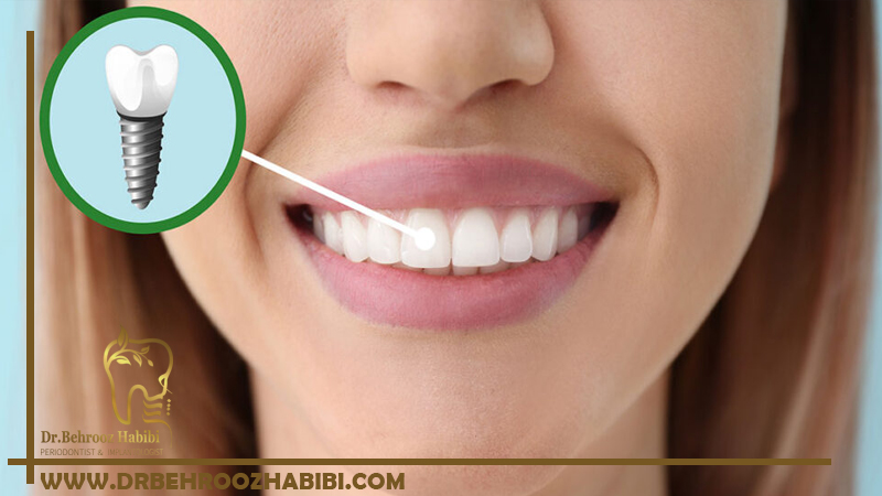 ایمپلنت دندانی در تهران