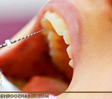 ترمیم دندان های آسیب دیده