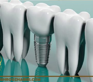 تفاوت تاج ها در ایمپلنت دندان
