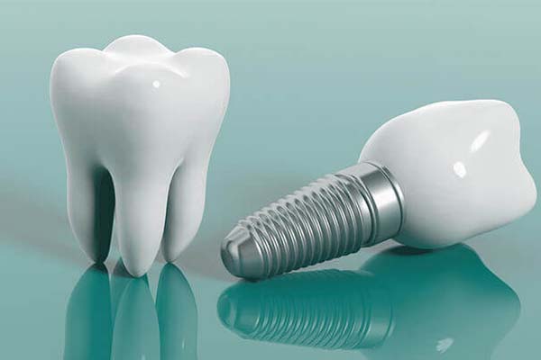 تفاوت تاج ها در ایمپلنت دندان
