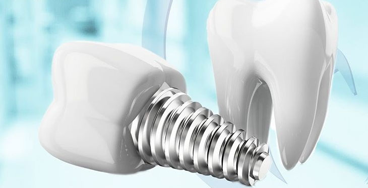 تفاوت تاج ها در ایمپلنت دندان