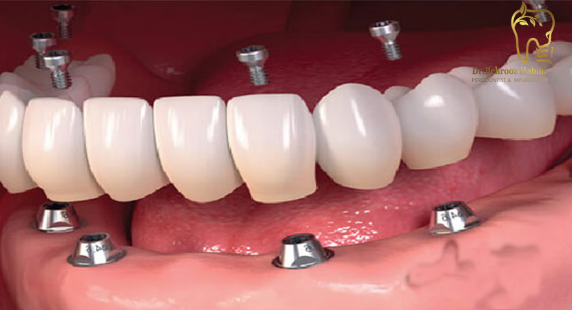 فرآیند ایمپلنت های دندانی