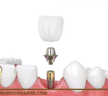 فرآیند ایمپلنت های دندانی