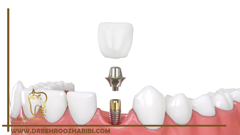 فرآیند ایمپلنت های دندانی