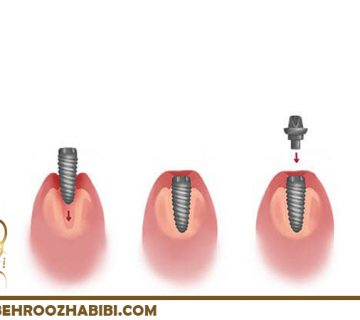 قرار دادن ایمپلنت دندان
