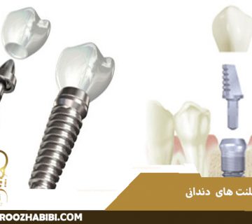 ایمپلنت های دندانی