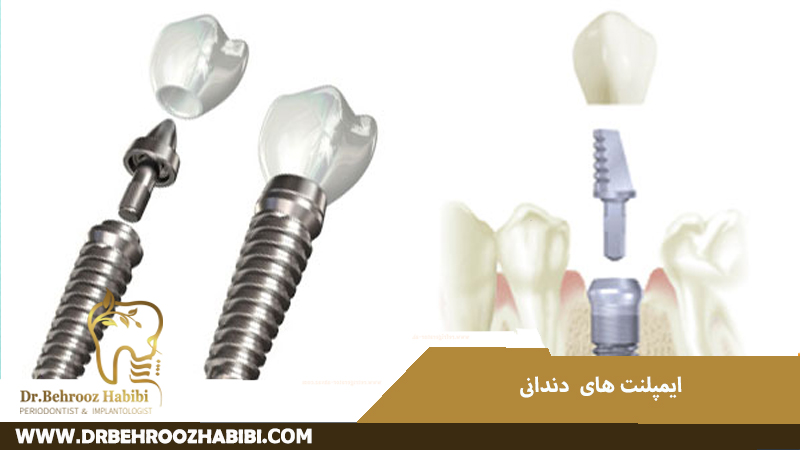 ایمپلنت های دندانی