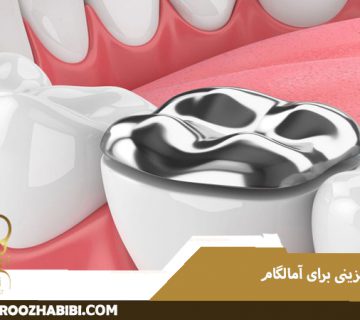 جایگزینی برای آمالگام