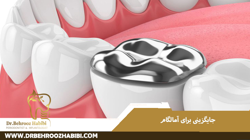 جایگزینی برای آمالگام