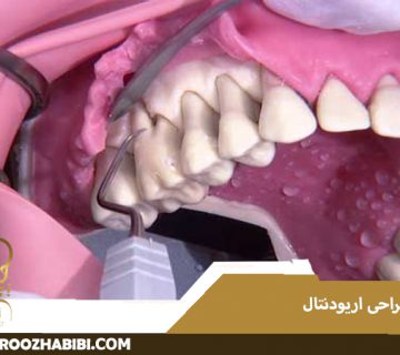 جراحی اریودنتال در تهران