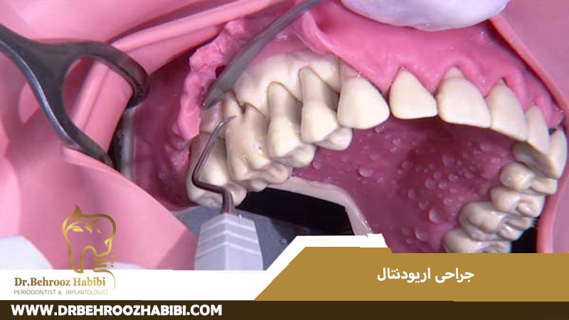 جراحی اریودنتال در تهران