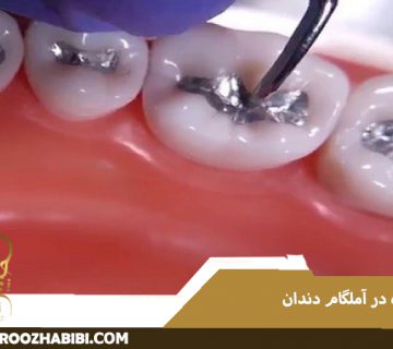 جیوه در آمالگام دندان