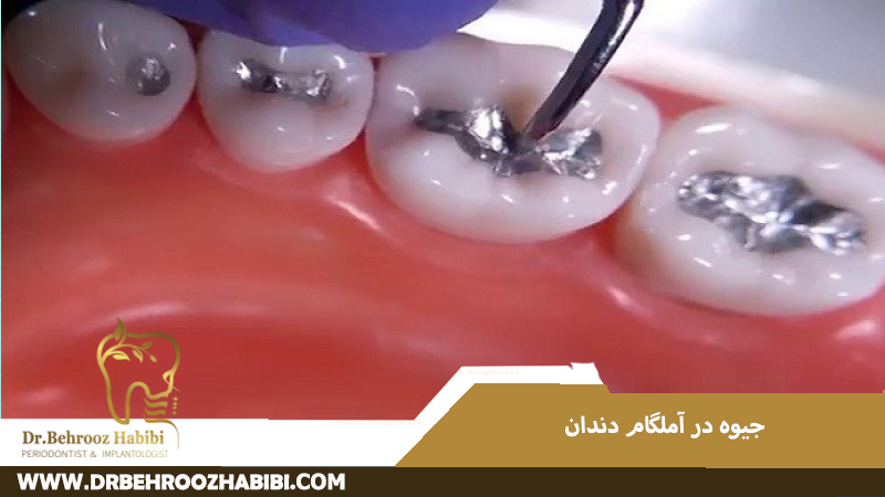جیوه در آمالگام دندان