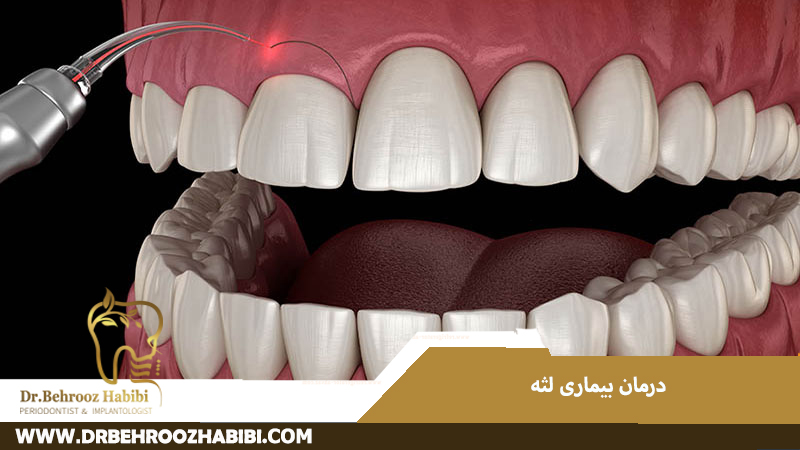 درمان بیماری لثه