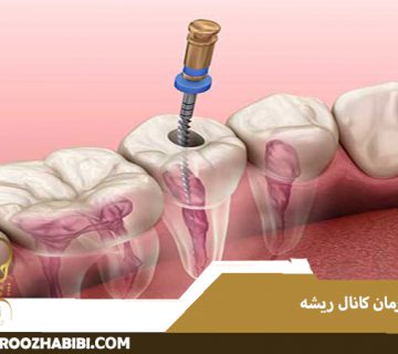 درمان کانال ریشه