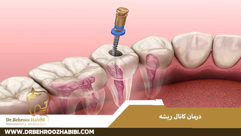 درمان کانال ریشه