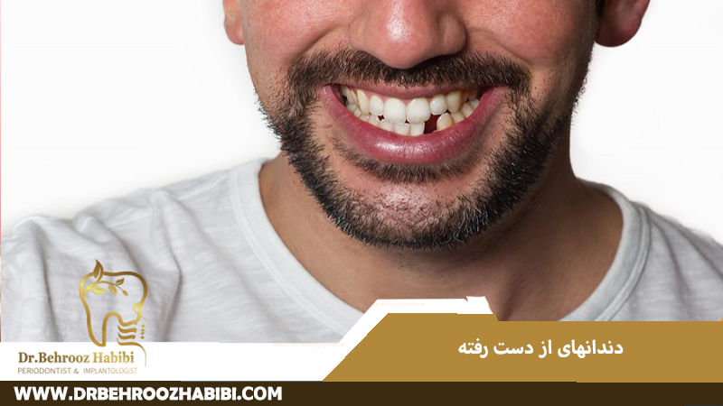 دندان های از دست رفته