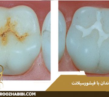 زیبایی دندان با فیشورسیلانت